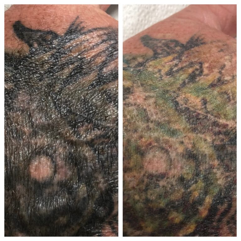 Laser Tattoo Removal Before and After 1 Session